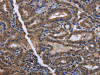 The image on the left is immunohistochemistry of paraffin-embedded Human thyroid cancer tissue using CSB-PA563111 (CYP3A4 Antibody) at dilution 1/40, on the right is treated with fusion protein. (Original magnification: ×200)