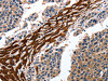 The image on the left is immunohistochemistry of paraffin-embedded Human liver cancer tissue using CSB-PA178836 (CYP3A4 Antibody) at dilution 1/15, on the right is treated with fusion protein. (Original magnification: ×200)