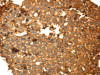 The image on the left is immunohistochemistry of paraffin-embedded Human breast cancer tissue using CSB-PA568903 (DRD5 Antibody) at dilution 1/40, on the right is treated with fusion protein. (Original magnification: ×200)
