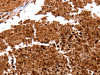 The image on the left is immunohistochemistry of paraffin-embedded Human lung cancer tissue using CSB-PA016840 (CLEC4A Antibody) at dilution 1/15, on the right is treated with fusion protein. (Original magnification: ×200)