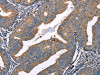 The image on the left is immunohistochemistry of paraffin-embedded Human cervical cancer tissue using CSB-PA919793 (DEFA1 Antibody) at dilution 1/10, on the right is treated with fusion protein. (Original magnification: ×200)