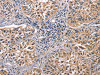 The image on the left is immunohistochemistry of paraffin-embedded Human lung cancer tissue using CSB-PA919793 (DEFA1 Antibody) at dilution 1/10, on the right is treated with fusion protein. (Original magnification: ×200)