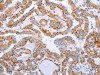 The image on the left is immunohistochemistry of paraffin-embedded Human thyroid cancer tissue using CSB-PA900594 (DTX2 Antibody) at dilution 1/15, on the right is treated with fusion protein. (Original magnification: ×200)