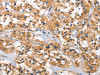 The image on the left is immunohistochemistry of paraffin-embedded Human thyroid cancer tissue using CSB-PA274333 (DKK3 Antibody) at dilution 1/30, on the right is treated with fusion protein. (Original magnification: ×200)