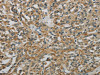 The image on the left is immunohistochemistry of paraffin-embedded Human esophagus cancer tissue using CSB-PA365158 (E2F6 Antibody) at dilution 1/60, on the right is treated with fusion protein. (Original magnification: ×200)