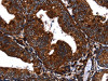 The image on the left is immunohistochemistry of paraffin-embedded Human cervical cancer tissue using CSB-PA942209 (EGF Antibody) at dilution 1/60, on the right is treated with fusion protein. (Original magnification: ×200)