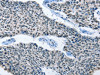 The image on the left is immunohistochemistry of paraffin-embedded Human lung cancer tissue using CSB-PA104194 (ELAVL1 Antibody) at dilution 1/50, on the right is treated with fusion protein. (Original magnification: ×200)