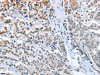 The image on the left is immunohistochemistry of paraffin-embedded Human prostate cancer tissue using CSB-PA104194 (ELAVL1 Antibody) at dilution 1/50, on the right is treated with fusion protein. (Original magnification: ×200)