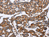 The image on the left is immunohistochemistry of paraffin-embedded Human breast cancer tissue using CSB-PA970254 (ENPP5 Antibody) at dilution 1/60, on the right is treated with fusion protein. (Original magnification: ×200)