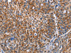The image on the left is immunohistochemistry of paraffin-embedded Human ovarian cancer tissue using CSB-PA970254 (ENPP5 Antibody) at dilution 1/60, on the right is treated with fusion protein. (Original magnification: ×200)