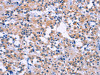 The image on the left is immunohistochemistry of paraffin-embedded Human thyroid cancer tissue using CSB-PA181246 (DUSP22 Antibody) at dilution 1/60, on the right is treated with fusion protein. (Original magnification: ×200)