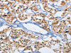 The image on the left is immunohistochemistry of paraffin-embedded Human thyroid cancer tissue using CSB-PA242652 (DUSP19 Antibody) at dilution 1/30, on the right is treated with fusion protein. (Original magnification: ×200)