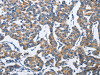 The image on the left is immunohistochemistry of paraffin-embedded Human breast cancer tissue using CSB-PA242652 (DUSP19 Antibody) at dilution 1/30, on the right is treated with fusion protein. (Original magnification: ×200)