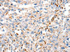 The image on the left is immunohistochemistry of paraffin-embedded Human esophagus cancer tissue using CSB-PA261651 (DUSP14 Antibody) at dilution 1/20, on the right is treated with fusion protein. (Original magnification: ×200)