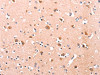 The image on the left is immunohistochemistry of paraffin-embedded Human brain tissue using CSB-PA229389 (DUSP12 Antibody) at dilution 1/25, on the right is treated with fusion protein. (Original magnification: ×200)