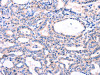 The image on the left is immunohistochemistry of paraffin-embedded Human thyroid cancer tissue using CSB-PA774733 (DUSP12 Antibody) at dilution 1/77, on the right is treated with fusion protein. (Original magnification: ×200)