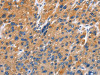 The image on the left is immunohistochemistry of paraffin-embedded Human liver cancer tissue using CSB-PA151323 (EDN3 Antibody) at dilution 1/40, on the right is treated with fusion protein. (Original magnification: ×200)
