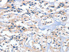 The image on the left is immunohistochemistry of paraffin-embedded Human thyroid cancer tissue using CSB-PA151323 (EDN3 Antibody) at dilution 1/40, on the right is treated with fusion protein. (Original magnification: ×200)