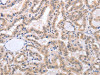 The image on the left is immunohistochemistry of paraffin-embedded Human thyroid cancer tissue using CSB-PA221364 (FADD Antibody) at dilution 1/50, on the right is treated with fusion protein. (Original magnification: ×200)