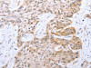 The image on the left is immunohistochemistry of paraffin-embedded Human esophagus cancer tissue using CSB-PA221364 (FADD Antibody) at dilution 1/50, on the right is treated with fusion protein. (Original magnification: ×200)
