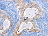 The image on the left is immunohistochemistry of paraffin-embedded Human cervical cancer tissue using CSB-PA114305 (CFLAR Antibody) at dilution 1/15, on the right is treated with fusion protein. (Original magnification: ×200)