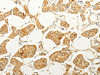 The image on the left is immunohistochemistry of paraffin-embedded Human breast cancer tissue using CSB-PA215116 (FOXR2 Antibody) at dilution 1/25, on the right is treated with fusion protein. (Original magnification: ×200)