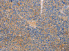 The image on the left is immunohistochemistry of paraffin-embedded Human liver cancer tissue using CSB-PA273344 (CXCL3 Antibody) at dilution 1/20, on the right is treated with fusion protein. (Original magnification: ×200)