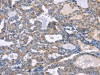 The image on the left is immunohistochemistry of paraffin-embedded Human thyroid cancer tissue using CSB-PA273344 (CXCL3 Antibody) at dilution 1/20, on the right is treated with fusion protein. (Original magnification: ×200)