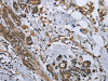 The image on the left is immunohistochemistry of paraffin-embedded Human breast cancer tissue using CSB-PA558316 (GDF3 Antibody) at dilution 1/25, on the right is treated with fusion protein. (Original magnification: ×200)