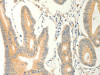 The image on the left is immunohistochemistry of paraffin-embedded Human colon cancer tissue using CSB-PA233398 (ERG Antibody) at dilution 1/40, on the right is treated with fusion protein. (Original magnification: ×200)