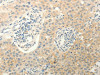 The image on the left is immunohistochemistry of paraffin-embedded Human lung cancer tissue using CSB-PA233398 (ERG Antibody) at dilution 1/40, on the right is treated with fusion protein. (Original magnification: ×200)