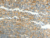 The image on the left is immunohistochemistry of paraffin-embedded Human tonsil tissue using CSB-PA589025 (CFHR1 Antibody) at dilution 1/40, on the right is treated with fusion protein. (Original magnification: ×200) The image on the left is immunohistochemistry of paraffin-embedded Human tonsil tissue using CSB-PA589025 (CFHR1 Antibody) at dilution 1/40, on the right is treated with fusion protein. (Original magnification: ×200)