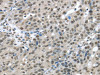 The image on the left is immunohistochemistry of paraffin-embedded Human breast cancer tissue using CSB-PA192926 (HDAC1 Antibody) at dilution 1/20, on the right is treated with fusion protein. (Original magnification: ×200)