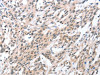 The image on the left is immunohistochemistry of paraffin-embedded Human esophagus cancer tissue using CSB-PA059735 (HDAC8 Antibody) at dilution 1/50, on the right is treated with fusion protein. (Original magnification: ×200)
