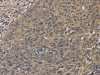 The image on the left is immunohistochemistry of paraffin-embedded Human cervical cancer tissue using CSB-PA225962 (HSF1 Antibody) at dilution 1/60, on the right is treated with fusion protein. (Original magnification: ×200)