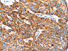 The image on the left is immunohistochemistry of paraffin-embedded Human esophagus cancer tissue using CSB-PA917523 (TRAP1 Antibody) at dilution 1/100, on the right is treated with fusion protein. (Original magnification: ×200)