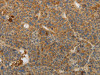The image on the left is immunohistochemistry of paraffin-embedded Human liver cancer tissue using CSB-PA592707 (IL27 Antibody) at dilution 1/10, on the right is treated with fusion protein. (Original magnification: ×200)