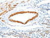 The image on the left is immunohistochemistry of paraffin-embedded Human colon cancer tissue using CSB-PA598310 (IMMT Antibody) at dilution 1/12, on the right is treated with fusion protein. (Original magnification: ×200) The image on the left is immunohistochemistry of paraffin-embedded Human colon cancer tissue using CSB-PA598310 (IMMT Antibody) at dilution 1/12, on the right is treated with fusion protein. (Original magnification: ×200)