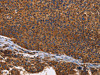 The image on the left is immunohistochemistry of paraffin-embedded Human liver cancer tissue using CSB-PA941698 (ILK Antibody) at dilution 1/60, on the right is treated with fusion protein. (Original magnification: ×200)