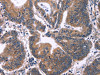 The image on the left is immunohistochemistry of paraffin-embedded Human colon cancer tissue using CSB-PA266125 (ING2 Antibody) at dilution 1/60, on the right is treated with fusion protein. (Original magnification: ×200)