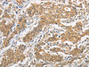 The image is immunohistochemistry of paraffin-embedded Human gastic cancer tissue using CSB-PA980626 (ITGB3BP Antibody) at dilution 1/50. (Original magnification: ×200)