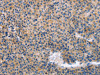 The image on the left is immunohistochemistry of paraffin-embedded Human liver cancer tissue using CSB-PA103566 (KLF15 Antibody) at dilution 1/30, on the right is treated with fusion protein. (Original magnification: ×200)