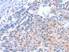 The image on the left is immunohistochemistry of paraffin-embedded Human breast cancer tissue using CSB-PA103566 (KLF15 Antibody) at dilution 1/30, on the right is treated with fusion protein. (Original magnification: ×200)