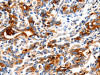 The image on the left is immunohistochemistry of paraffin-embedded Human gastric cancer tissue using CSB-PA039843 (KLK15 Antibody) at dilution 1/15, on the right is treated with fusion protein. (Original magnification: ×200)