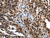 The image on the left is immunohistochemistry of paraffin-embedded Human ovarian cancer tissue using CSB-PA257066 (XRCC6 Antibody) at dilution 1/10, on the right is treated with fusion protein. (Original magnification: ×200)