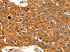 The image on the left is immunohistochemistry of paraffin-embedded Human esophagus cancer tissue using CSB-PA080360 (SERPINB5 Antibody) at dilution 1/60, on the right is treated with fusion protein. (Original magnification: ×200)