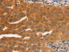The image on the left is immunohistochemistry of paraffin-embedded Human ovarian cancer tissue using CSB-PA080360 (SERPINB5 Antibody) at dilution 1/60, on the right is treated with fusion protein. (Original magnification: ×200)