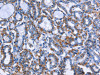 The image on the left is immunohistochemistry of paraffin-embedded Human thyroid cancer tissue using CSB-PA989166 (MPO Antibody) at dilution 1/50, on the right is treated with fusion protein. (Original magnification: ×200)