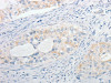 The image on the left is immunohistochemistry of paraffin-embedded Human cervical cancer tissue using CSB-PA437340 (MPZ Antibody) at dilution 1/15, on the right is treated with fusion protein. (Original magnification: ×200)
