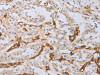The image on the left is immunohistochemistry of paraffin-embedded Human thyroid cancer tissue using CSB-PA590716 (MYL6 Antibody) at dilution 1/40, on the right is treated with fusion protein. (Original magnification: ×200)
